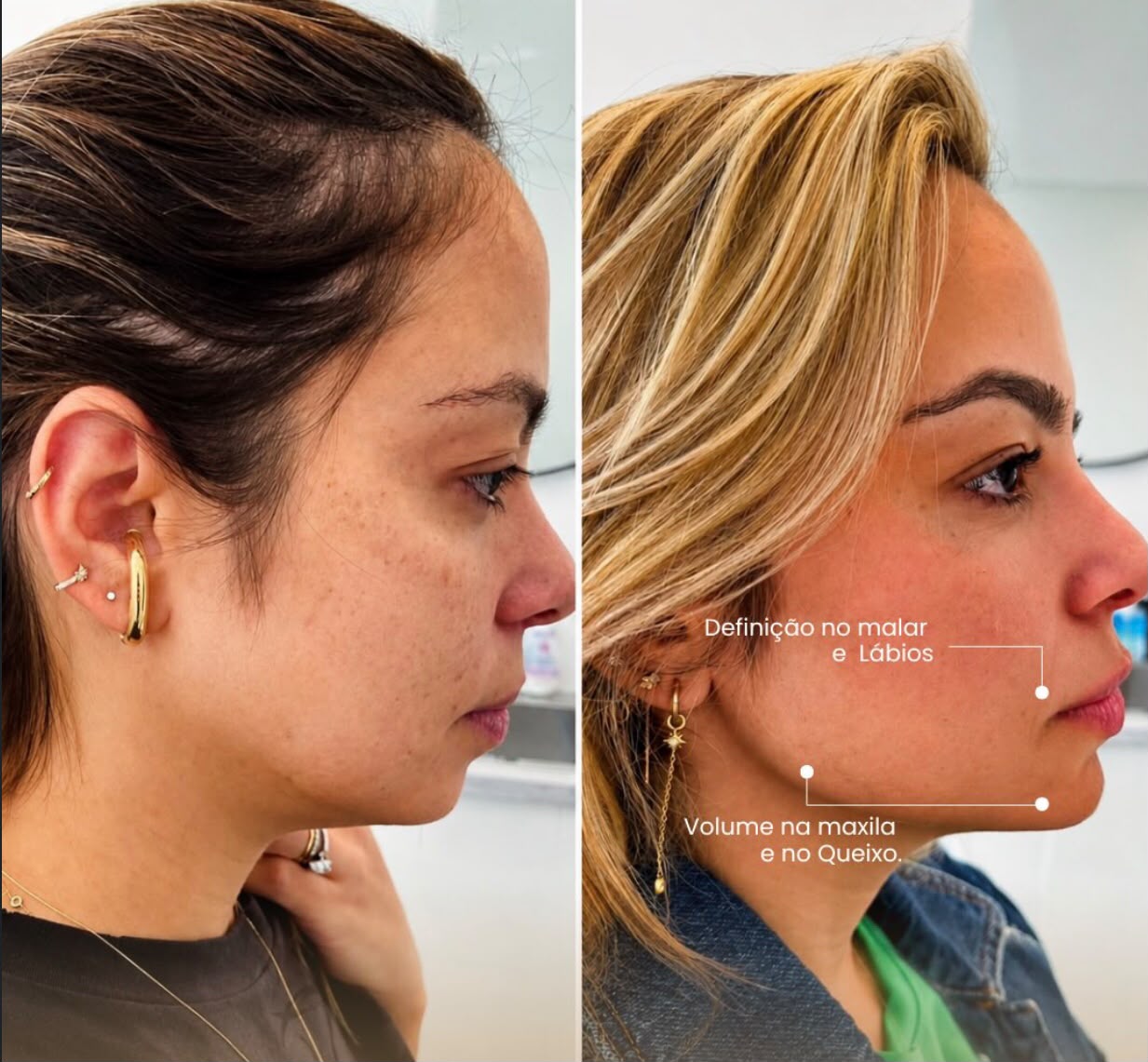 Preenchimento labial — Dra. Fabianne Figueiredo