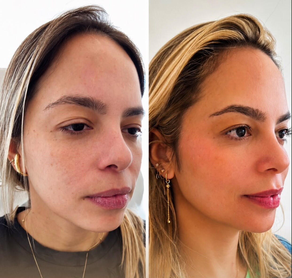 Preenchimento Malar — Dra. Fabianne Figueiredo
