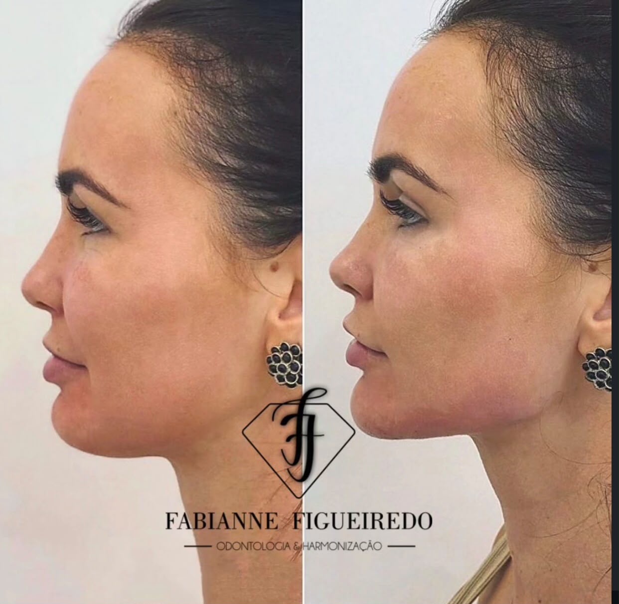 Resultado de Harmonização Orofacial — Dra. Fabianne Figueiredo