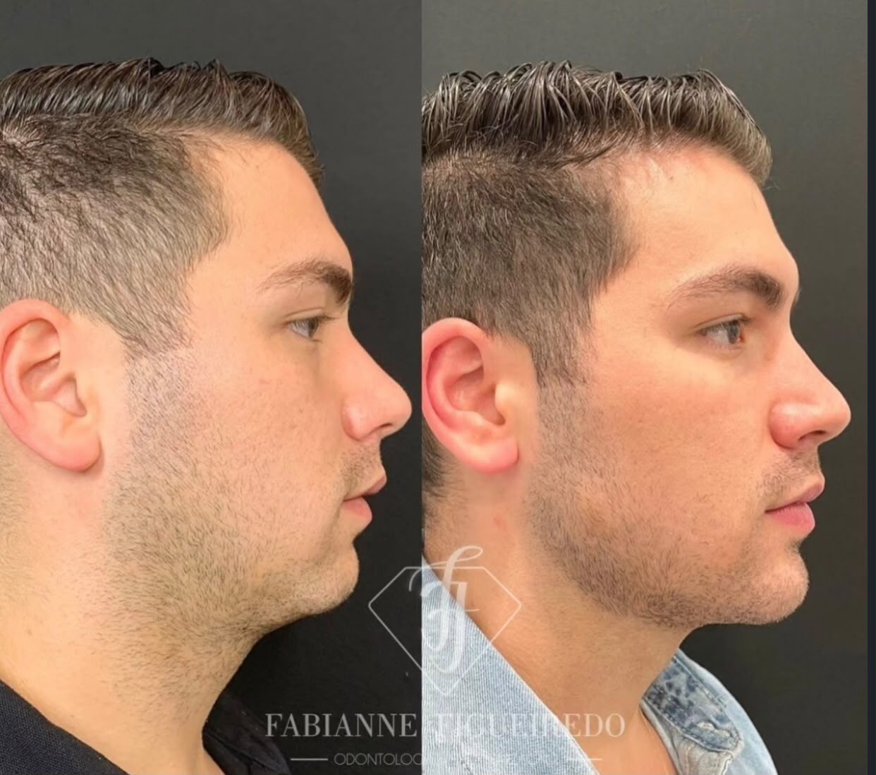 Resultado de Harmonização Orofacial — Dra. Fabianne Figueiredo