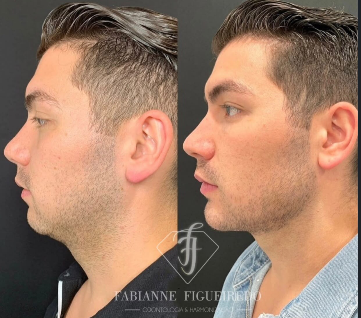 Resultado de Harmonização Orofacial — Dra. Fabianne Figueiredo