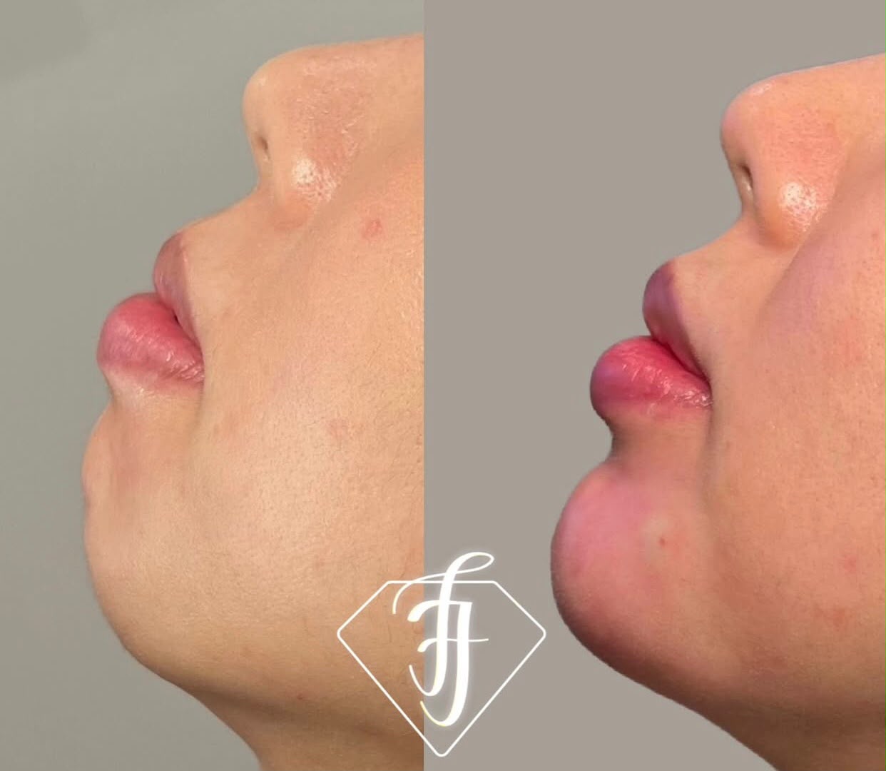 Resultado de Harmonização Orofacial — Dra. Fabianne Figueiredo