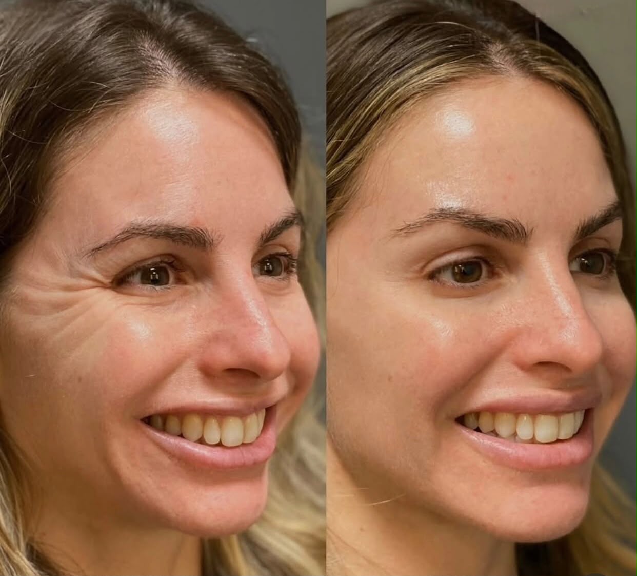 Resultado de Harmonização Orofacial — Dra. Fabianne Figueiredo