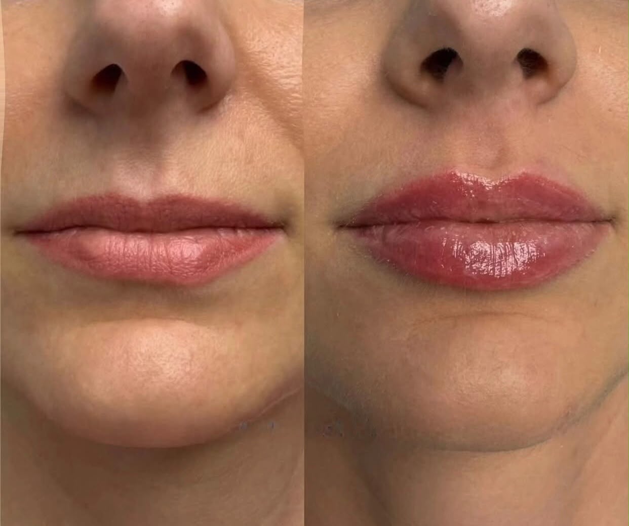 Resultado de Harmonização Orofacial — Dra. Fabianne Figueiredo